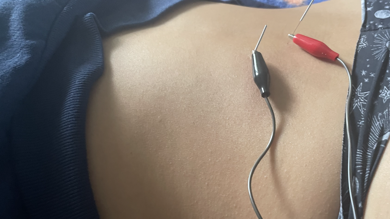 dry needling
